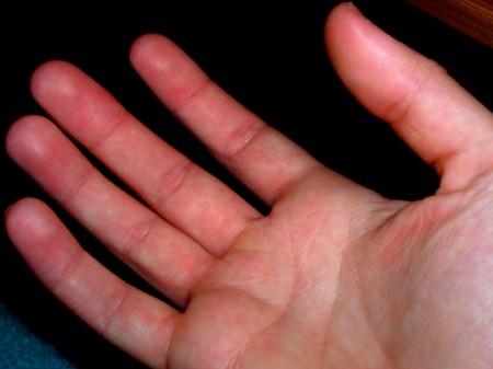 Blotches on the Palm of a Hand | LIVESTRONG.COM
